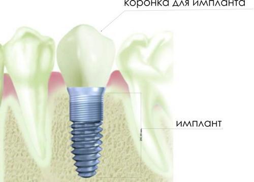 Имплантация зубов в Минске. Стоимость зубных имплантов. Стоматология Минск. Стоматологические клиники. Ортопед.  Терапевт. Ортодонт. Хирург. Стоматологии Минск. Стоматологические услуги. Стоматологии. Услуги по лечению зубов, услуги по протезированию зубов, установка брекетов, удаление зубов, стоматология, протезирование зубов, реставрация зубов, металлокерамика, имплантация зубов, шинирование, отбеливание зубов, брекеты, импланты, чистка зубов, зубные щетки, лечение зуба (лечить зубы), удаление зуба, зубы (зуб) мудрости и их удаление, зубная боль - нет, зуб болит, зубы и протезирование, удалить зуб, лечить зуб, лечить флюс, установить брекеты, зубы отбелить, установить виниры, ортодонт, терапевт, хирург, пародонтолог