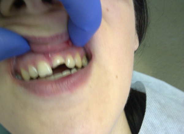 восстановление зубов