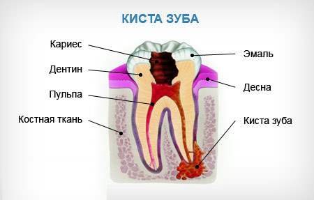 удаление кисты зуба