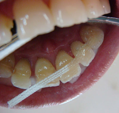 шинирование зубов в минске
