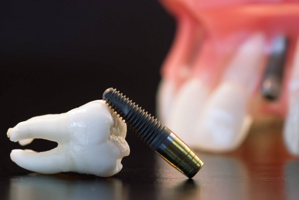 zubnoj-implant-pod-klyuch-1024x686.jpg