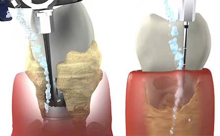 пародонтологическая чистка карманов в Минске